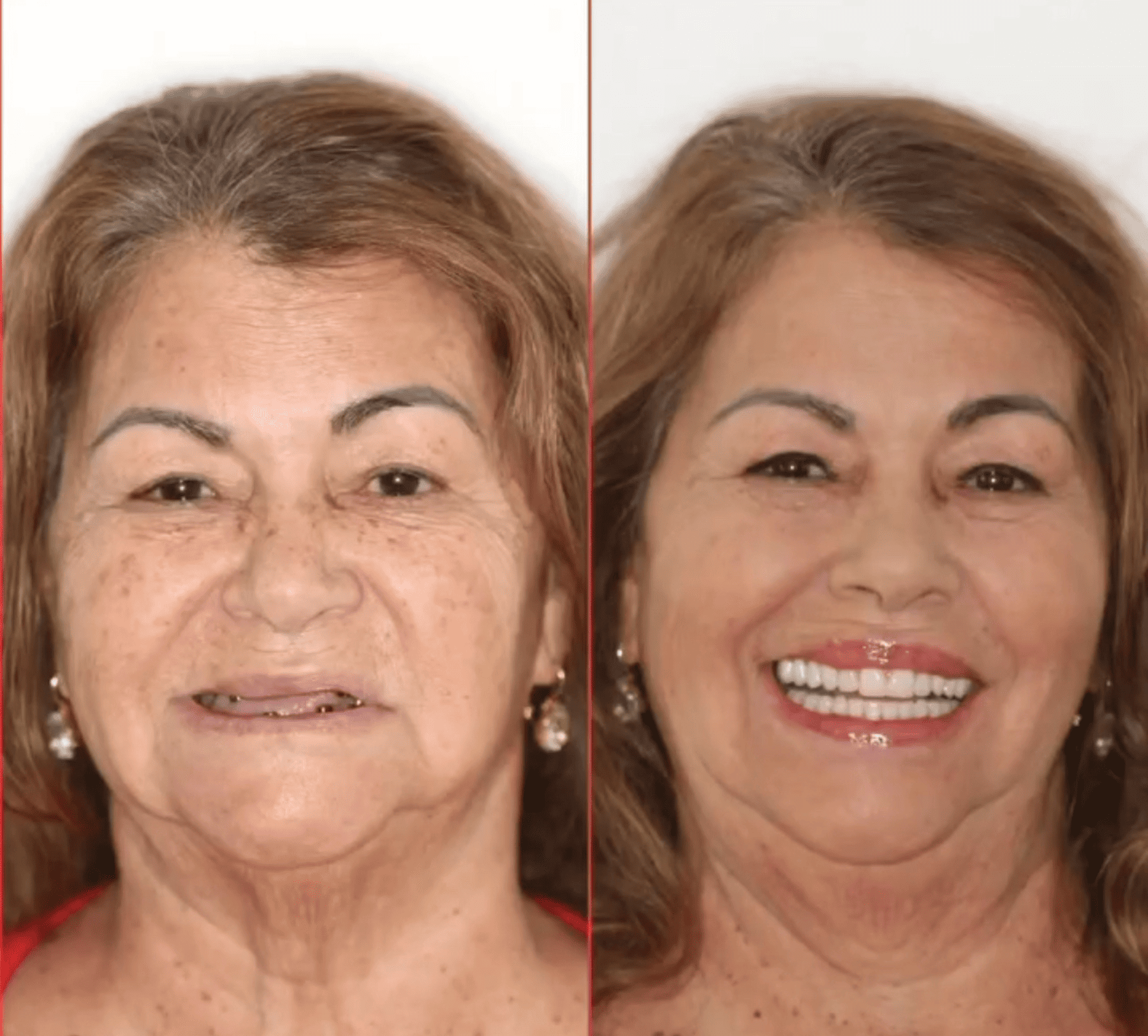 implante-dentario-belo-horizonte-dr-alysson-ramos-3-1.png
