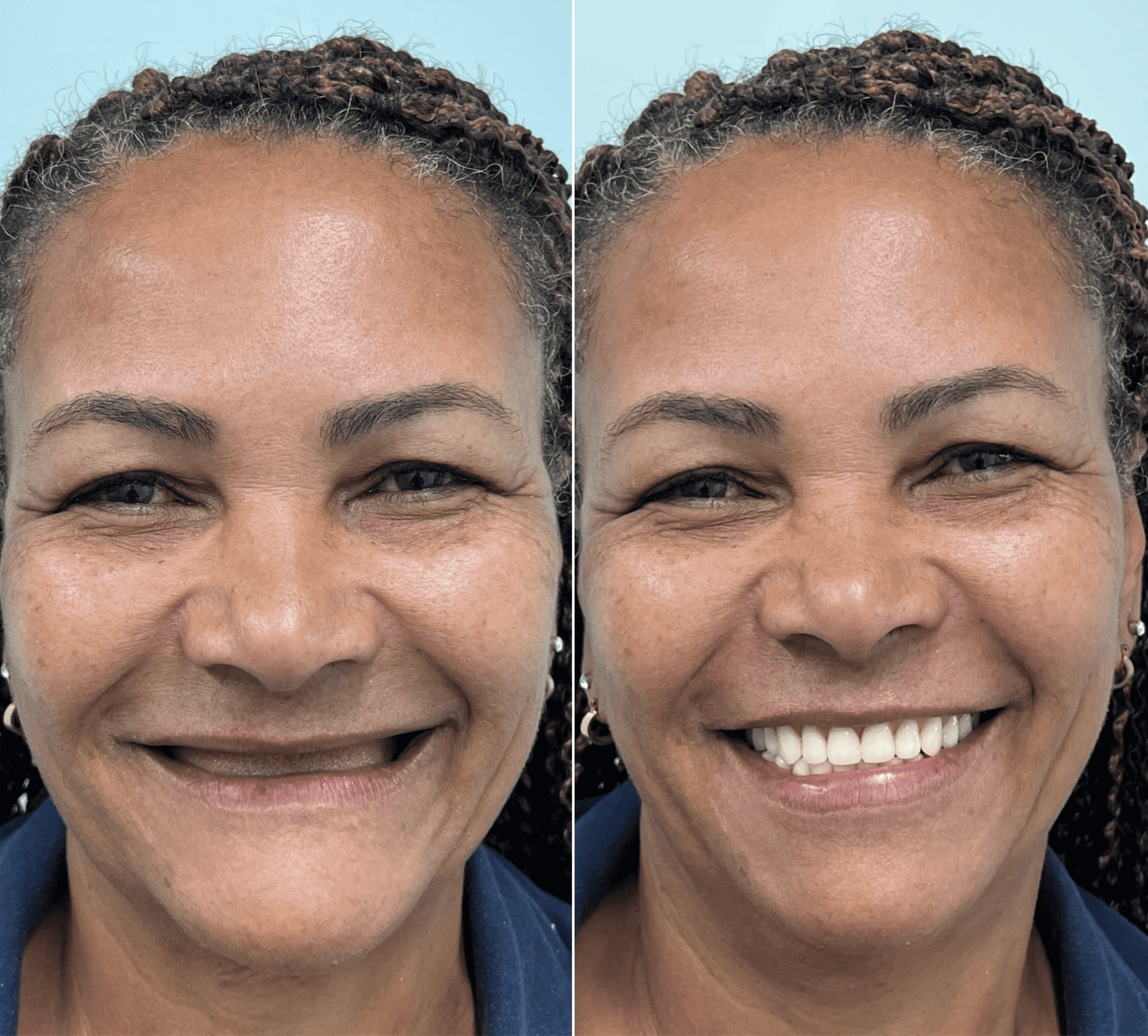 implante-dentario-belo-horizonte-dr-alysson-ramos-6-1.png