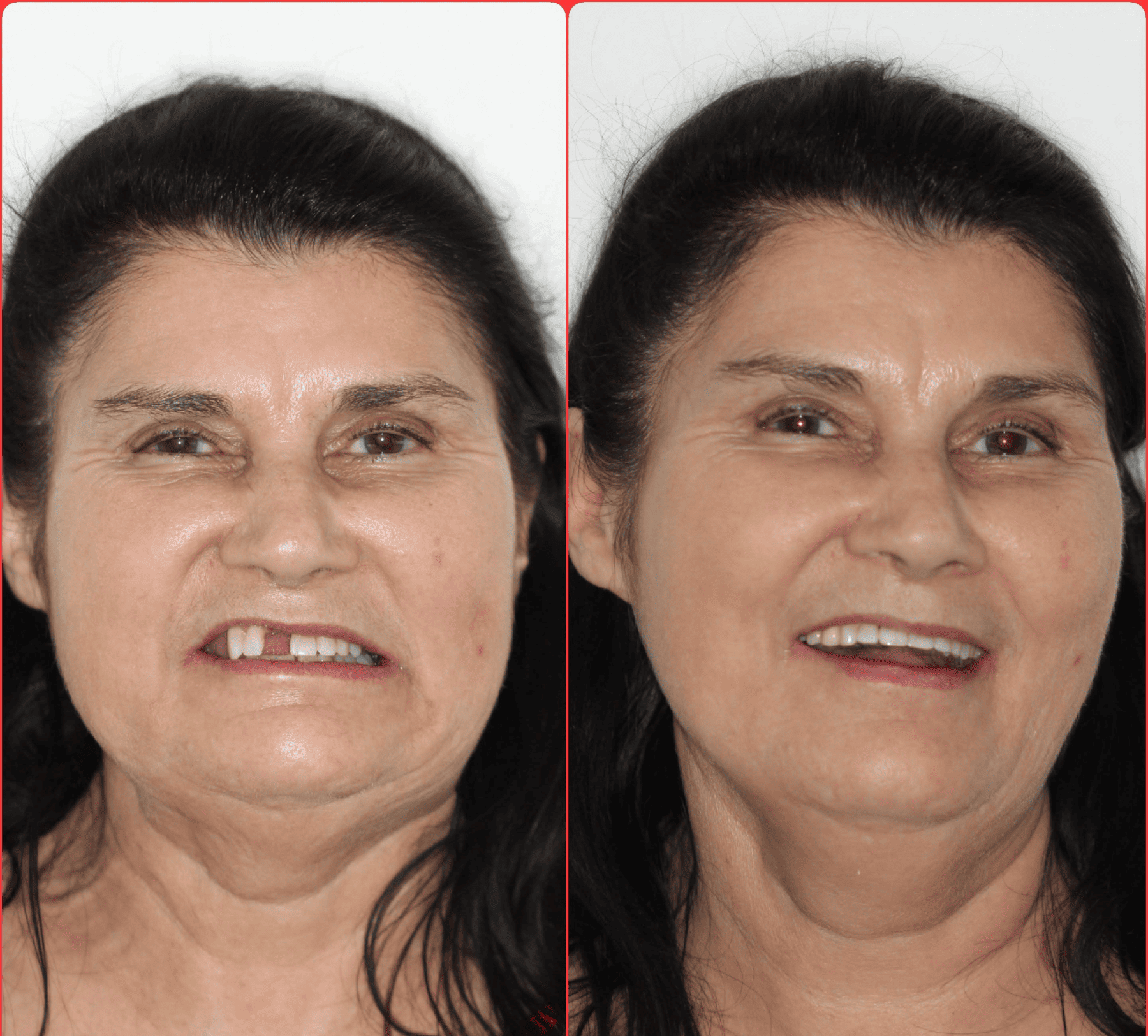 implante-dentario-belo-horizonte-dr-alysson-ramos-7-1.png